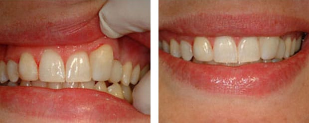 Bonding Case1 P 1 Continued