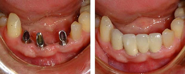 Implants P 1 Continued