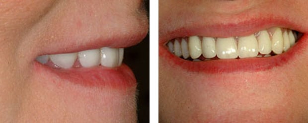 Implants P 2 Continued