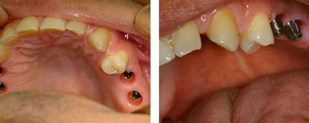 Implants P 5 Continued