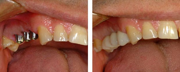 Implants P 6 Continued