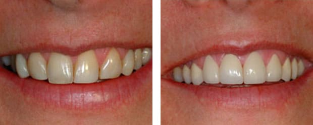 Veneers Upper Case2