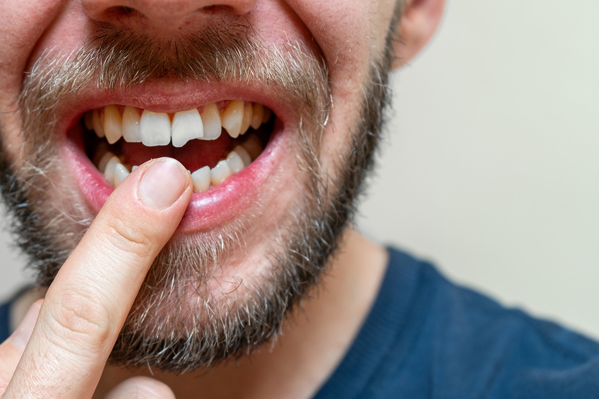 Broken tooth swelling or infection how emergency dentists prioritize care blog