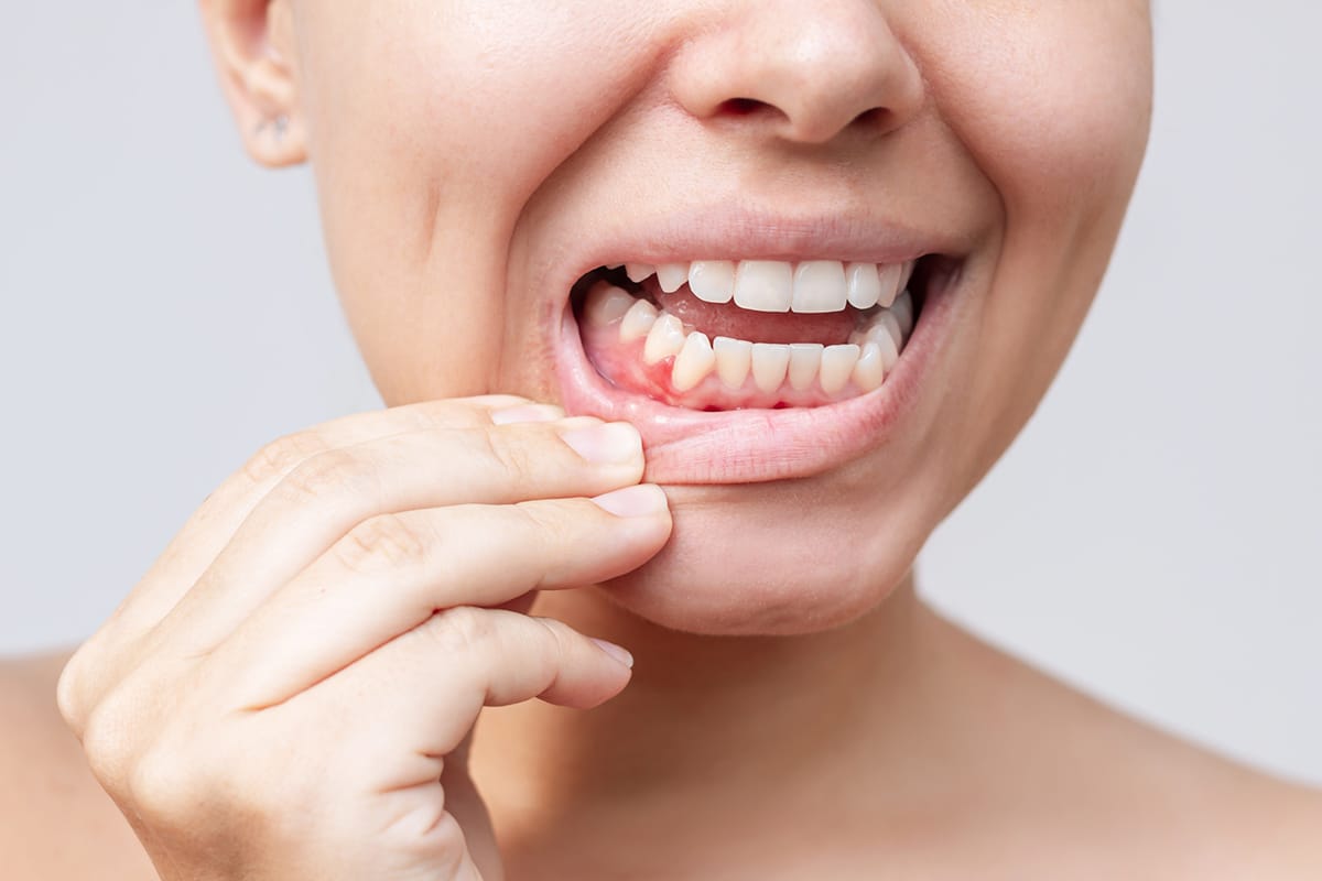 Early signs of gum disease most patients ignore until its serious blog