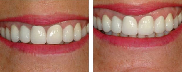 Veneers Case1 P 1 Continued