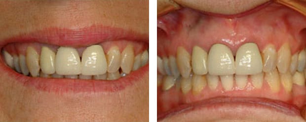 Veneers Case1 P 1
